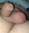 hypospadia_dick